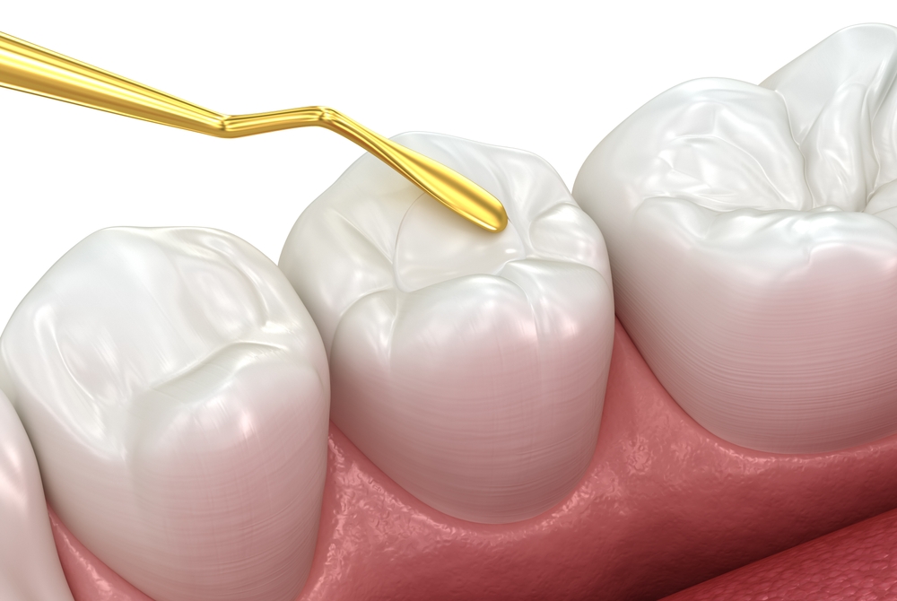 restorative fillings, and when are they needed