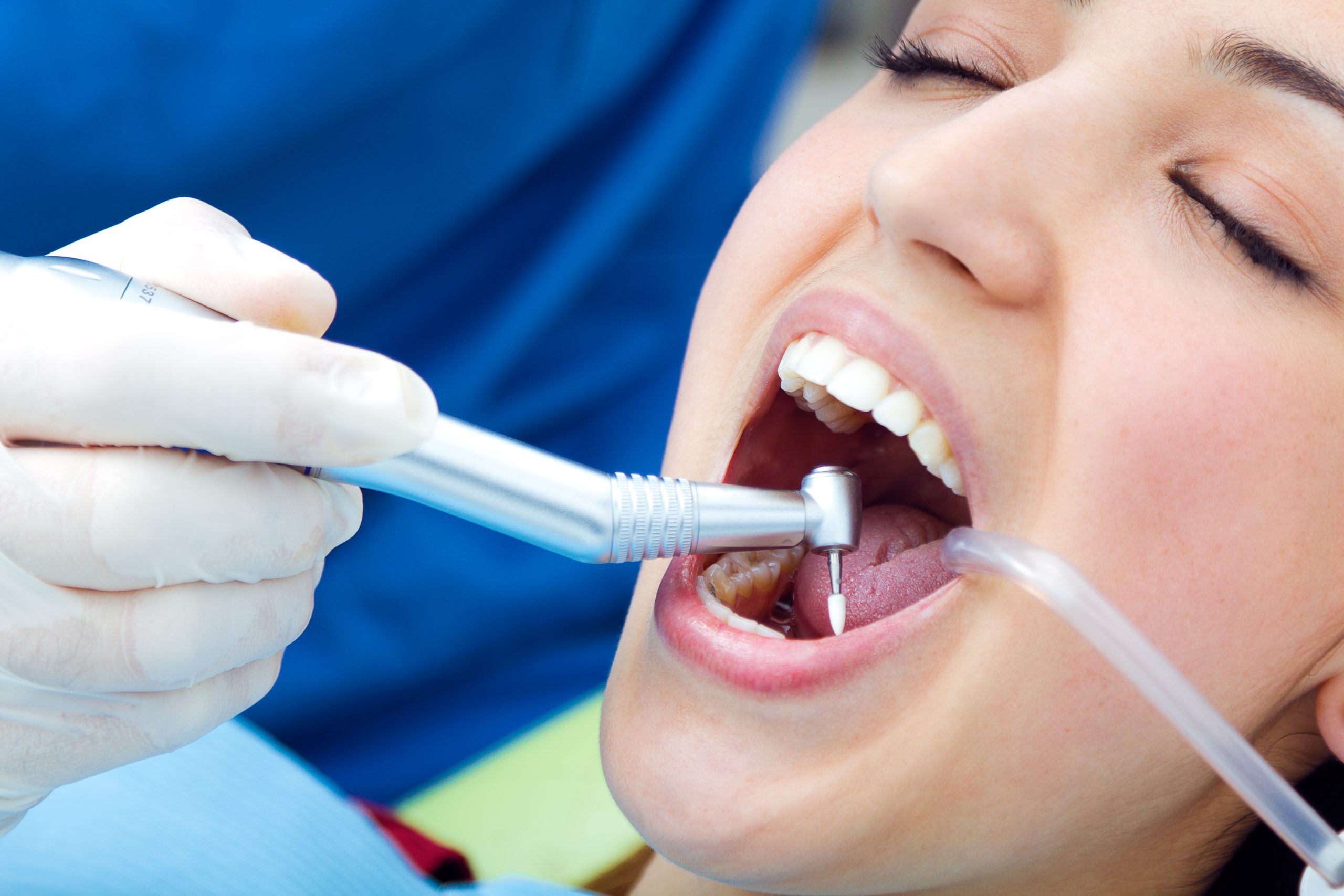 dental sealants protect teeth from cavities